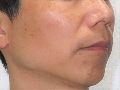 顔のシミ治療前　右側