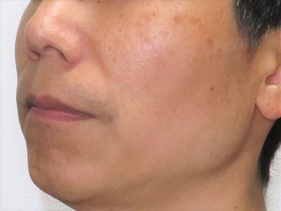 顔のシミ治療前　左側