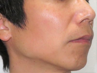 顔のシミ治療後　右側