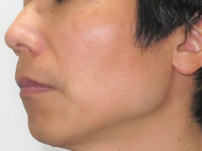 顔のシミ治療後　左側